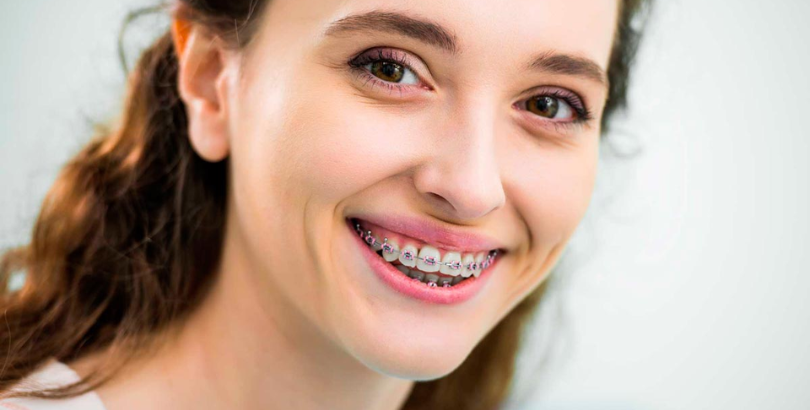 A Simple Guide to Different Types of Braces