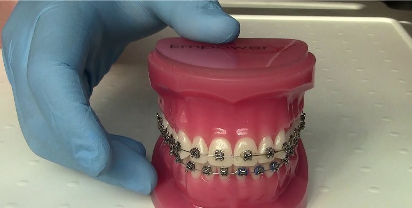 braces treatment in gangapur road Nashik