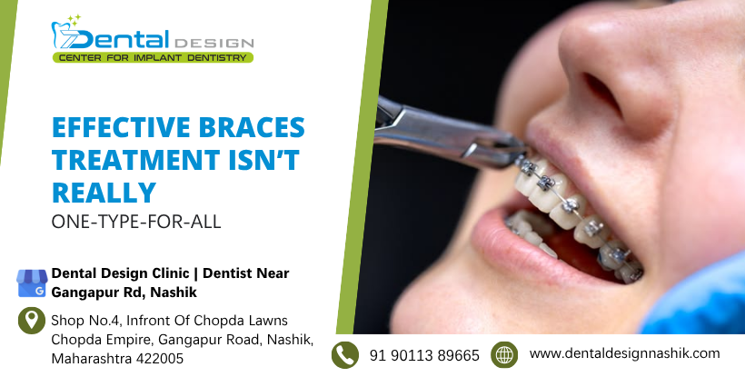 Effective Braces Treatment Isn’t Really One-Type-For-All