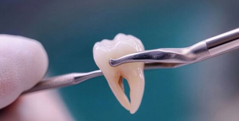 wisdom tooth removal cost in gangapur road Nashik