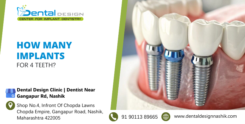 How many implants for 4 teeth?