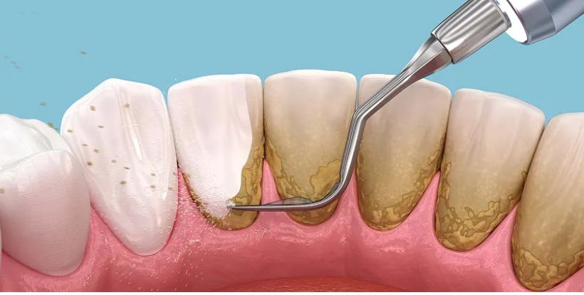 teeth cleaning cost in Nashik