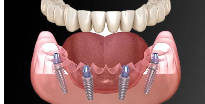 all on 4 implant in gangapur road Nashik