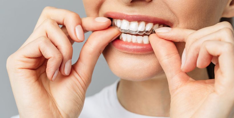 aligners treatment in gangapur road Nashik