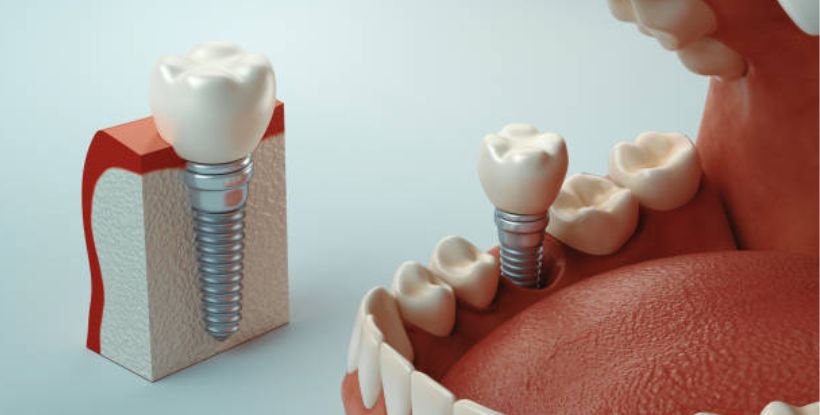 dental implants in Nashik