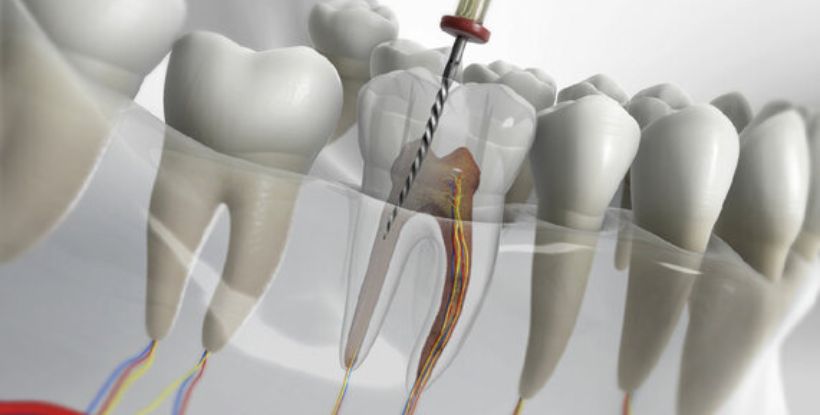root canal treatment cost in Nashik