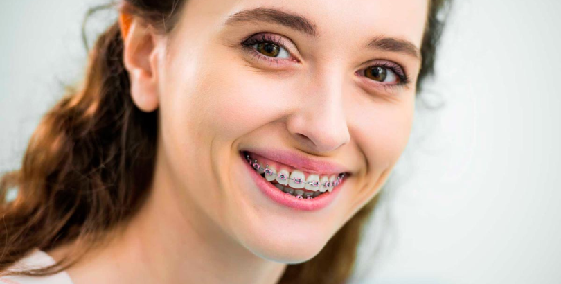 Types of Braces