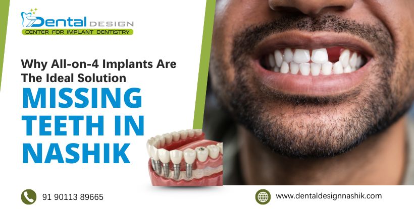 all on 4 implant in Nashik