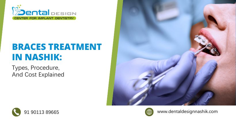 Braces Treatment in Nashik: Types, Procedure, and Cost Explained