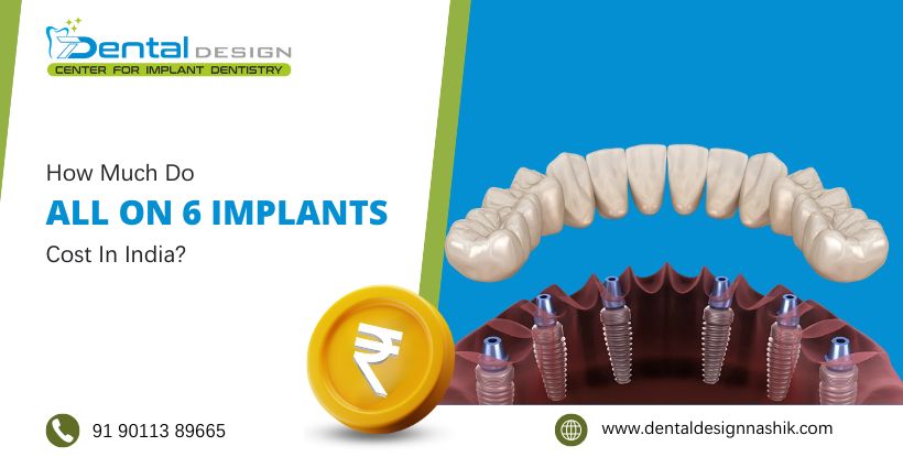 How Much Do All-On-6 Implants Cost In Nashik?