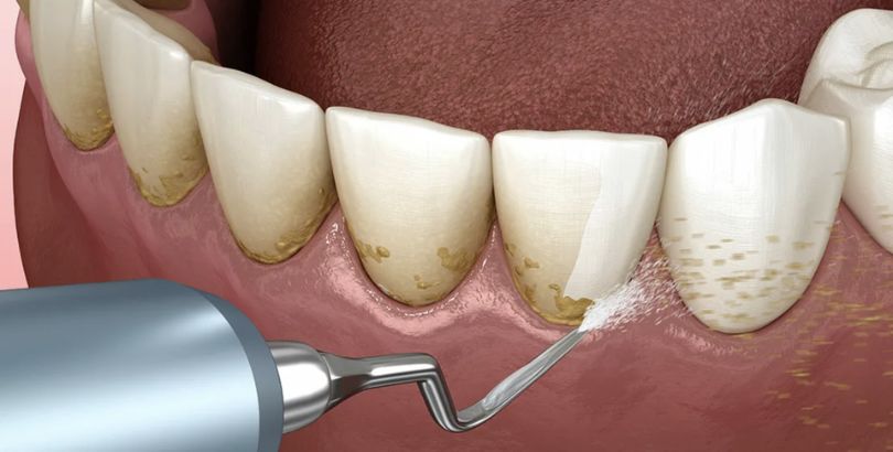 Dental Teeth Cleaning