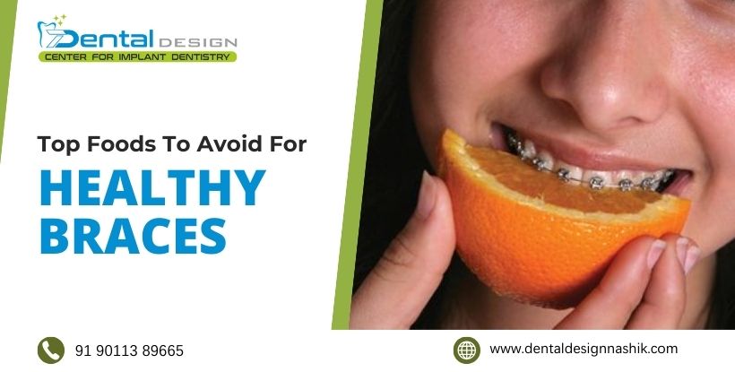 Top Foods to Avoid for Healthy Braces