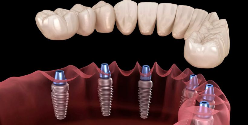 Full Mouth Rehabilitation