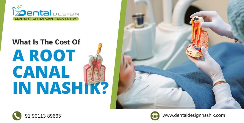 Cost Of A Root Canal In Nashik