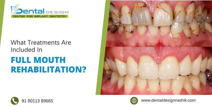 full mouth rehabilitation