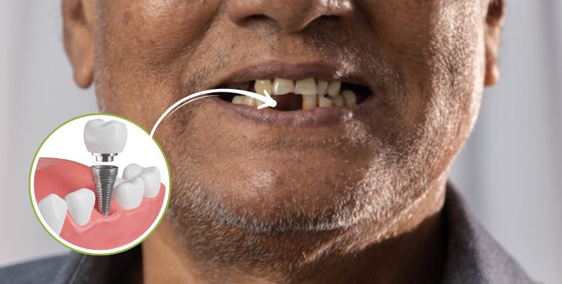dental implant treatment in Nashik