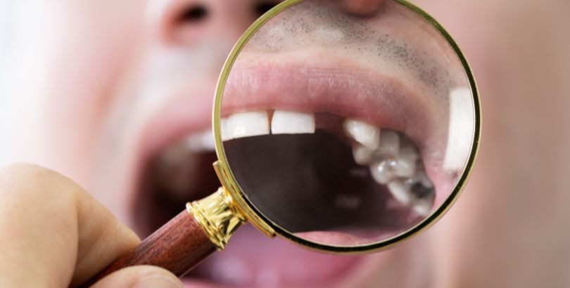 Why You Should Consider Missing Teeth Replacement